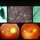Blastomycosis Blastomycosis